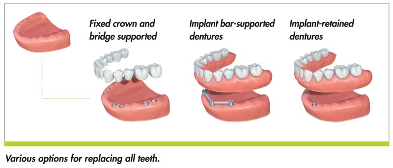 Lower Dentures Polkville NC 28136